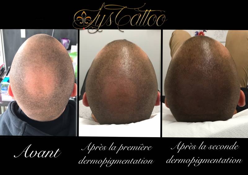 Tatouage médical tricopigmentation perte de cheveux alopécie calvitie proche Bordeaux Pessac Mérignac BÈGLES Arcachon biganos mios 